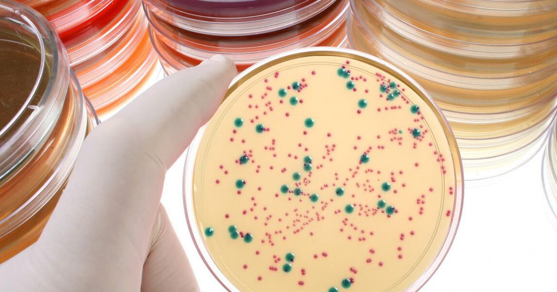 Eine chronische bakterielle Prostatitis wird durch die Analyse von Urin und Prostatasekret erkannt